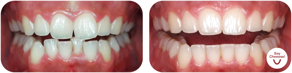 Crowded teeth treated with invisible braces in Vienna
