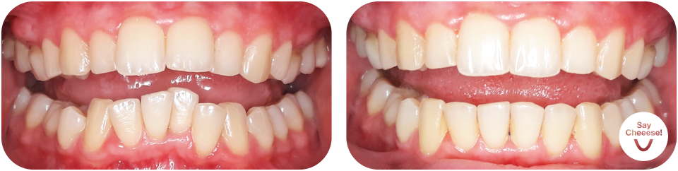 Crowding treated with invisible braces at SayCheeese Vienna