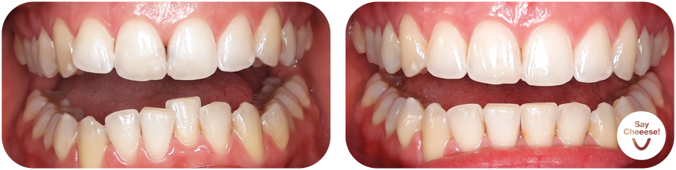 Crowding treated with invisible braces at SayCheeese Vienna
