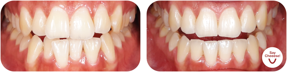 Crowding treated with invisible braces at SayCheeese Vienna