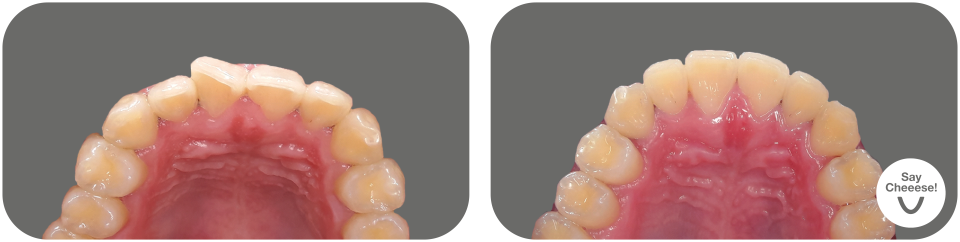Crowding treated with invisible braces at SayCheeese Vienna