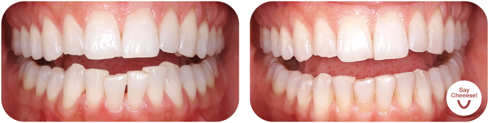 Crowding treated with invisible braces at SayCheeese Vienna