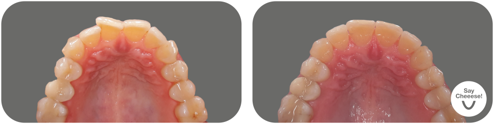 Crowding treated with invisible braces at SayCheeese Vienna