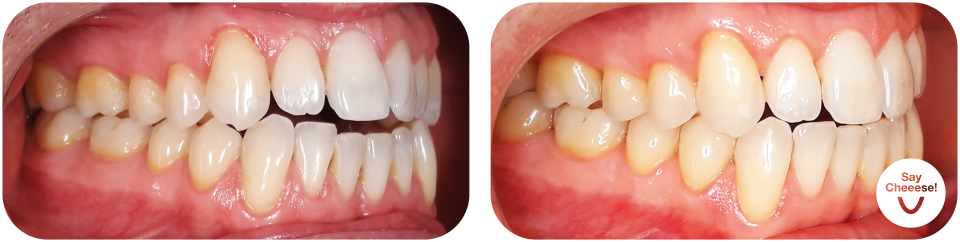 Open bite treated with invisible braces at SayCheeese Vienna