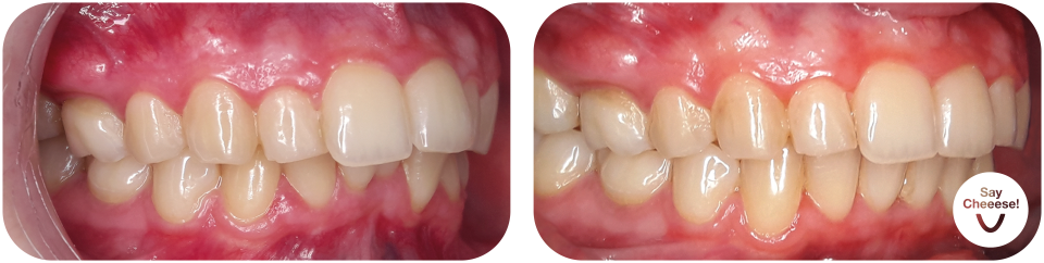 Underbite treated with invisible braces at SayCheeese Vienna