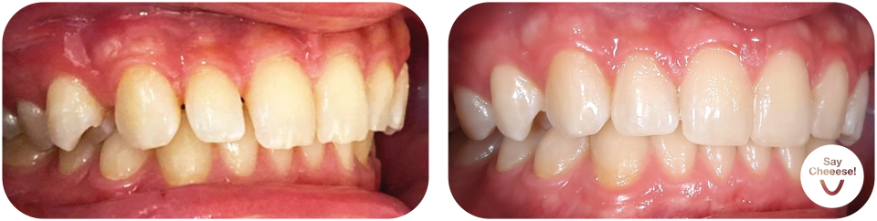 Underbite treated with invisible braces at SayCheeese Vienna