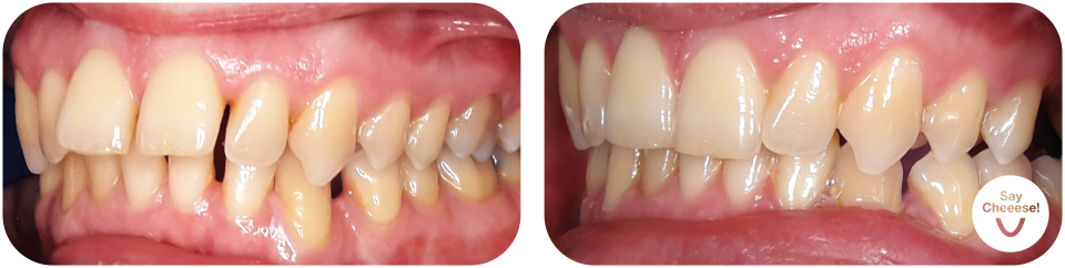 Protruding front teeth treated with invisible braces Vienna