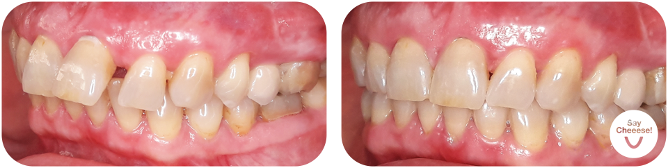 Protruding front teeth treated with invisible braces at SayCheeese Vienna