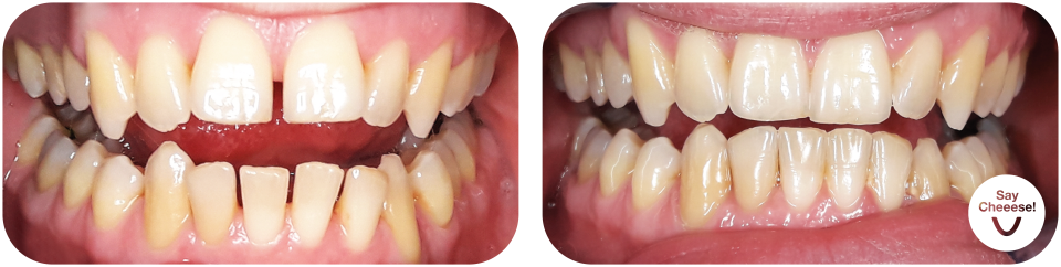Gap between the teeth treated with invisible braces at SayCheeese Vienna