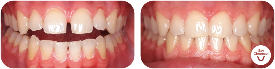 Gap between the teeth treated with invisible braces at SayCheeese Vienna