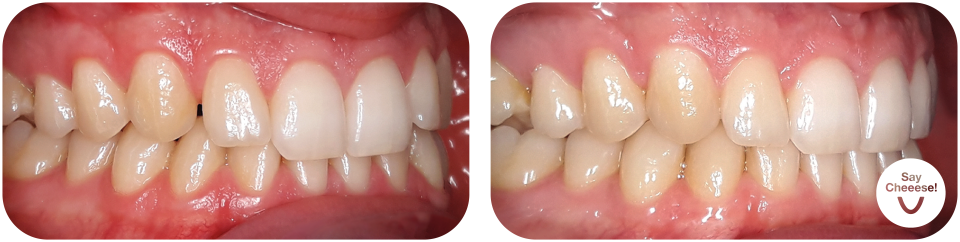 Gap between the teeth treated with invisible braces at SayCheeese Vienna