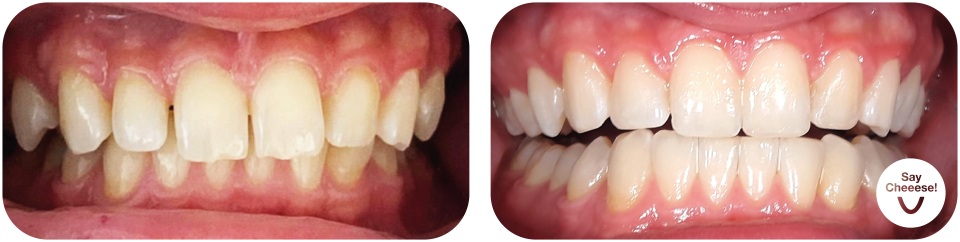 Gap between the teeth treated with invisible braces at SayCheeese Vienna
