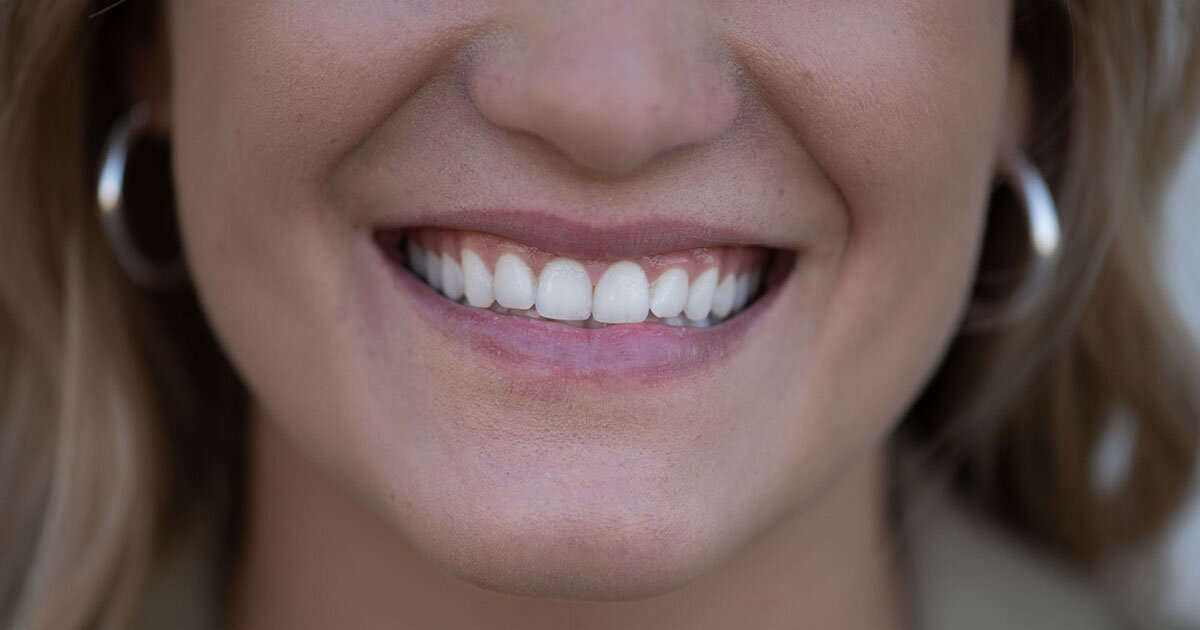 >Aligner oder feste Zahnspange – was passt zu mir?