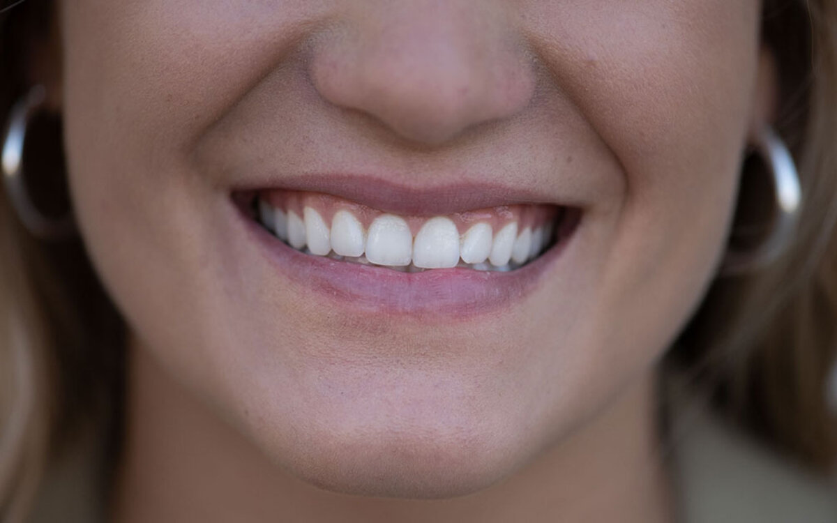 >Aligner oder feste Zahnspange – was passt zu mir?