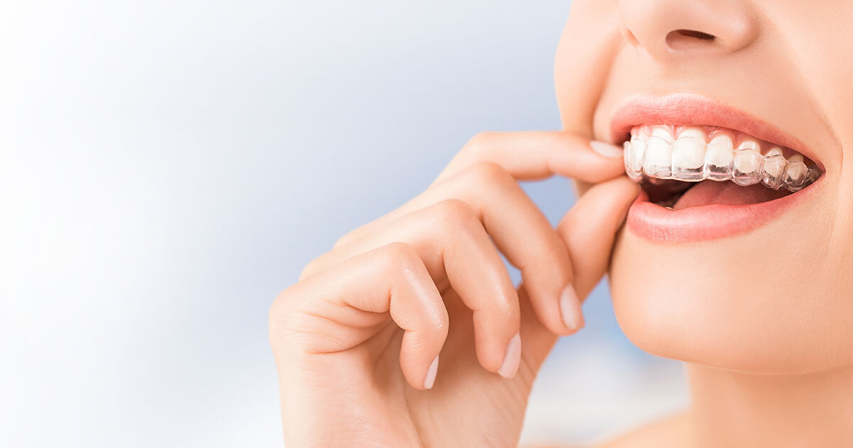 >Was kostet eine Zahnspange für Jugendliche in Wien – und welche Faktoren beeinflussen den Preis?