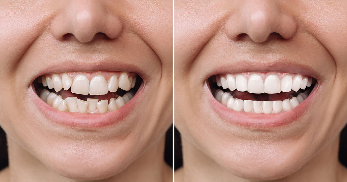 SayCheeese, the invisible braces from Vienna