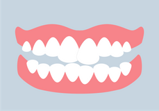 Engstand mit Zahnspange behandeln