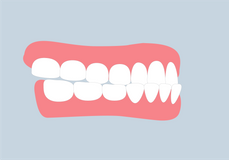 Rückbiss mit Zahnspange behandeln