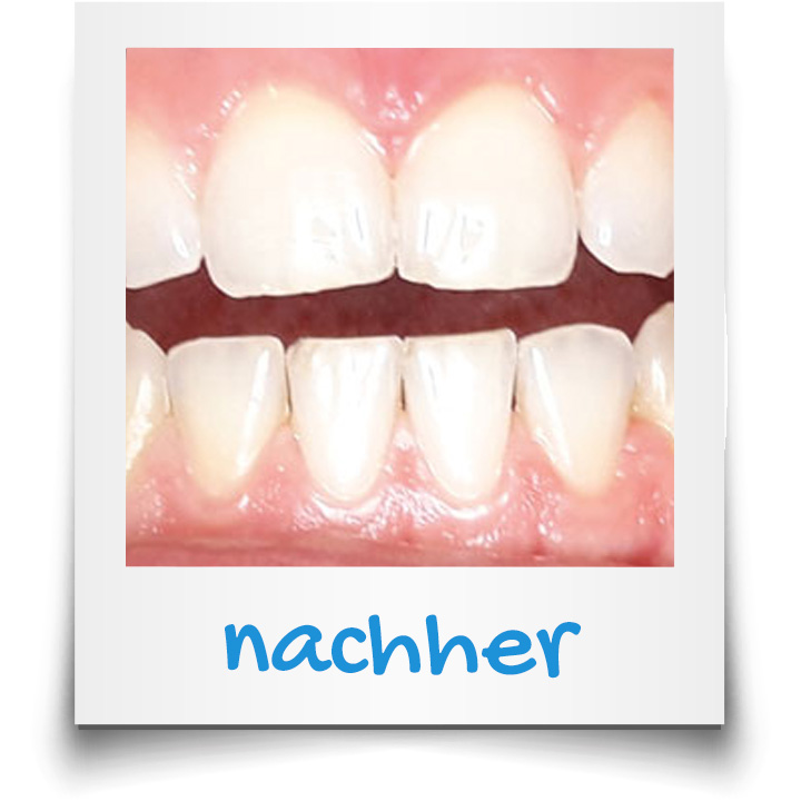 Gap between the teeth after treatment with Invisalign aligners in Vienna