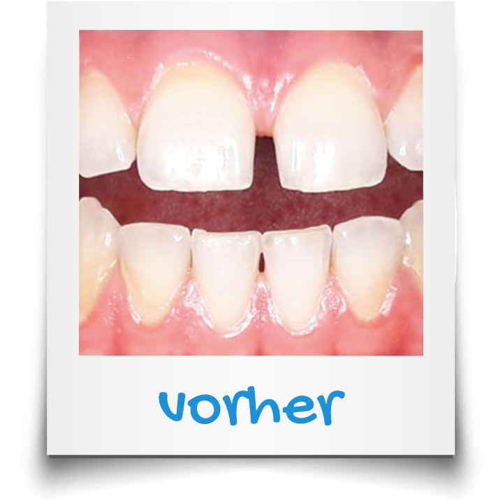 Gap between the teeth before treatment with invisible braces in Vienna