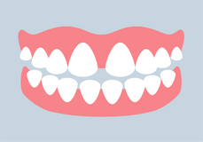 Zahnlücken mit Zahnspange behandeln