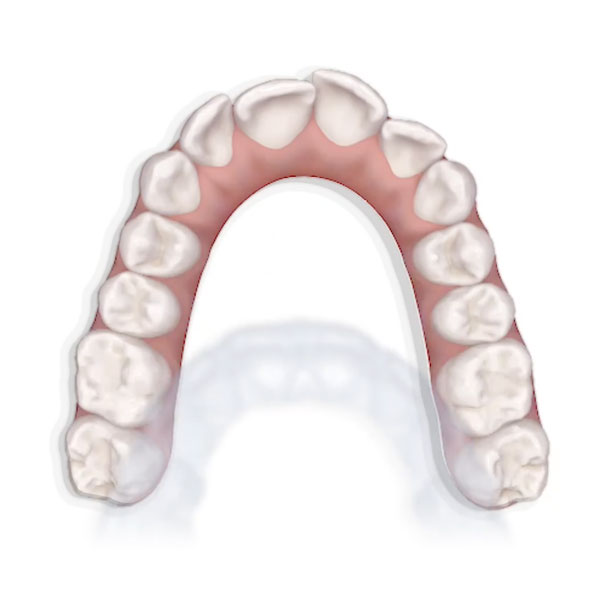 3D rendering of a dental arch with a clear aligner